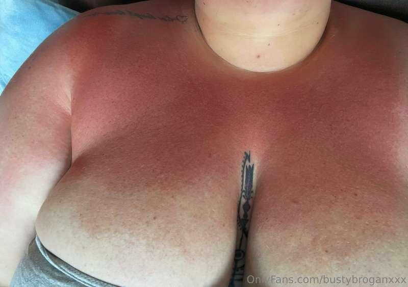I went to the beach and burnt my titties. Will you rub after..