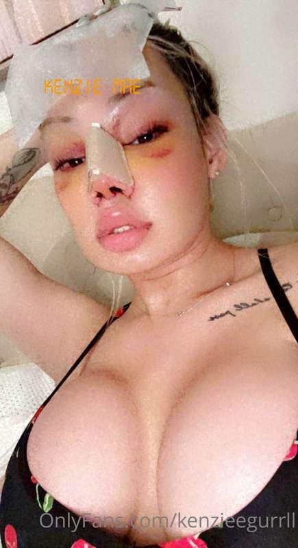 I just had surgery so that’s why I haven’t posted but can’t ..