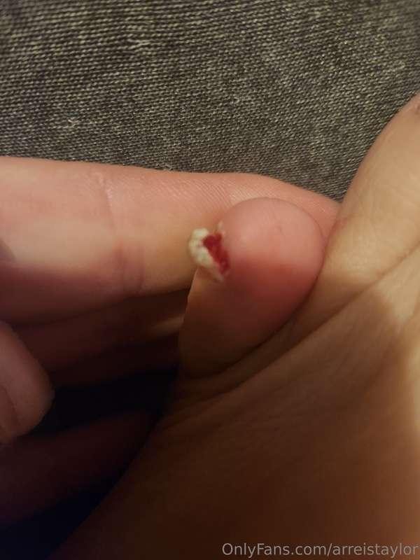 😭😭😭 stubbed it on my bedframe 😭😭😭