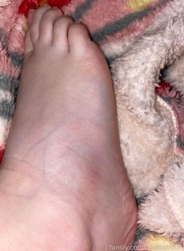i was coming down a latter and thought i was at the bottom but i wasn’t and i fell and landed on my ankle and now my foot is bruised and swollen 🙃 