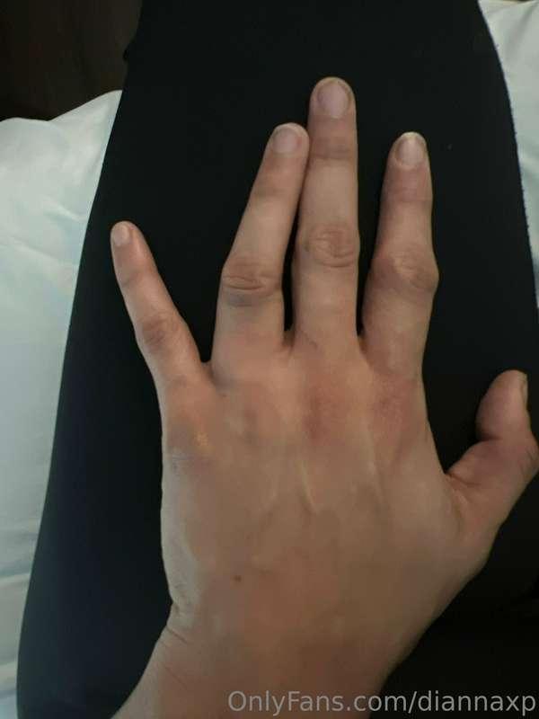 My first filming injury 😅

Anyone know how to fix a dislocat..