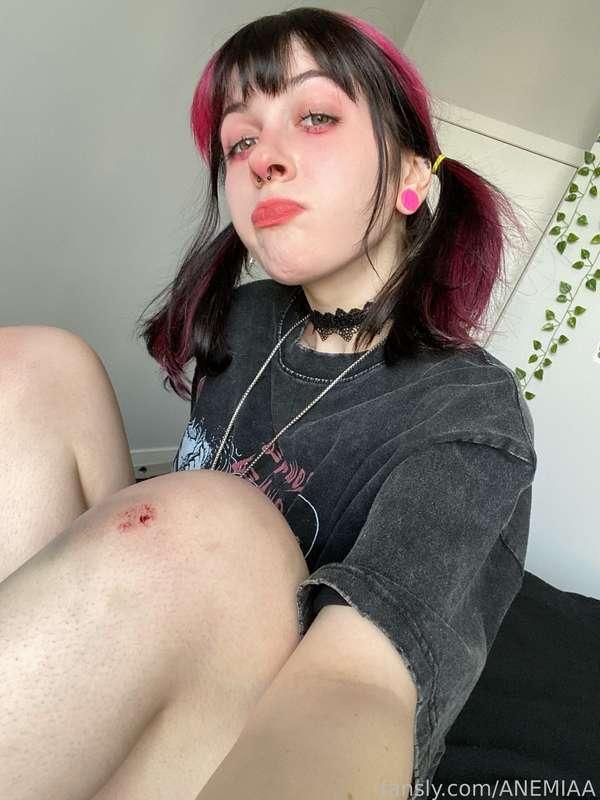 anemiaa image #6