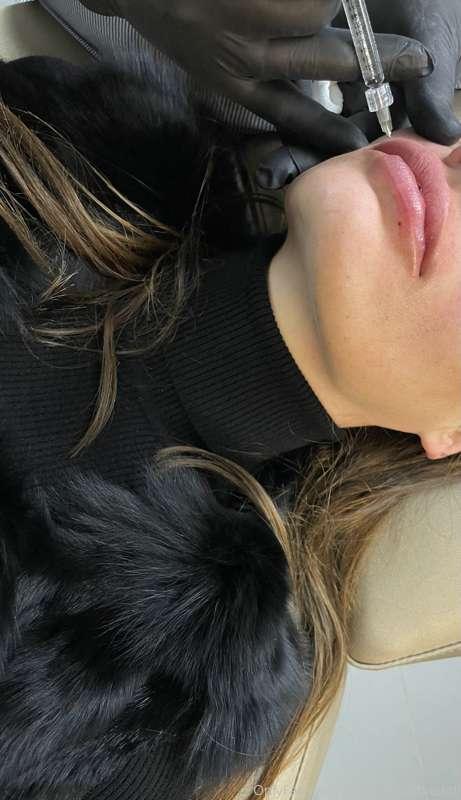 Just got my lips injected? Would u like to see the swelling ..