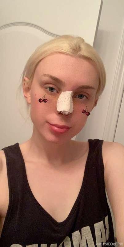 5 days and my new bandage comes off my nose and i can start ..