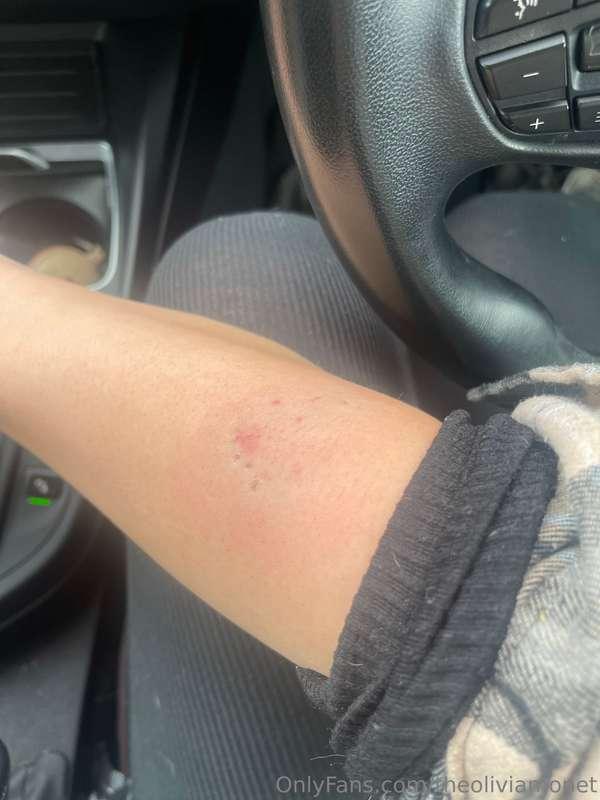 What a week, just been bitten by a dog 😭😭 if you see a big b..