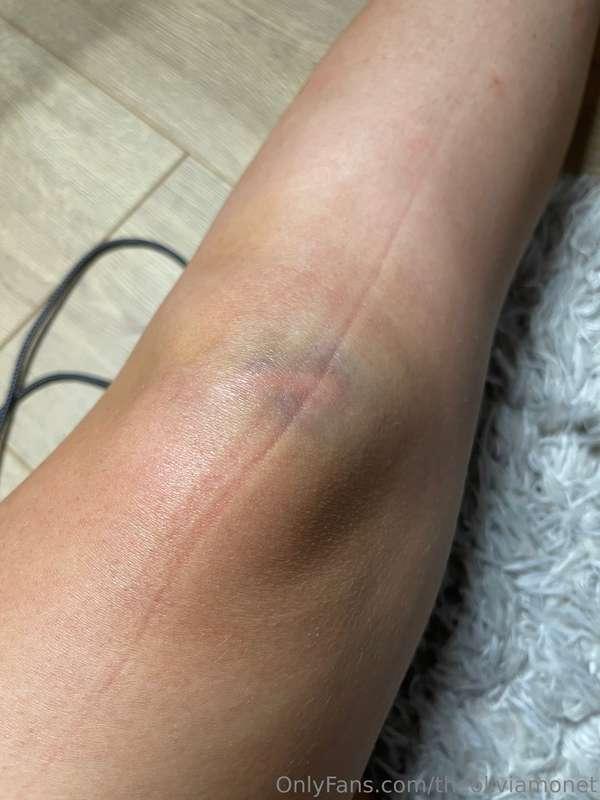 Day 1 it hurts so much but I can stand on it 😅