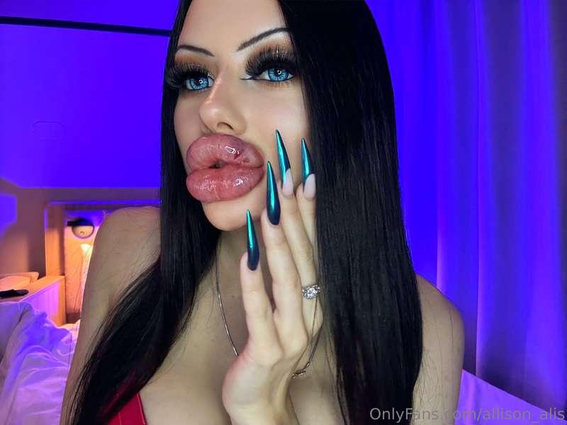 MY BIGGEST SWOLLEN LIPS EVER💉 NEW VIDEO🤩 Super bruised lips ..