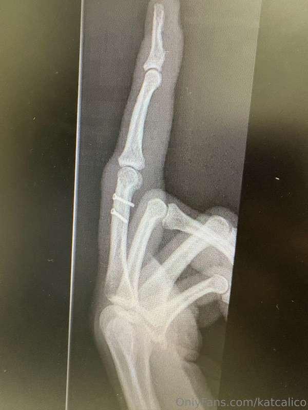 I went to the Dr today August 25. They said I’m still broken..