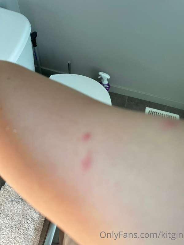 I’m back! With some mosquito attacks :,)