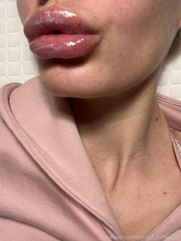 These are my lips today after the injection yesterday... sti..