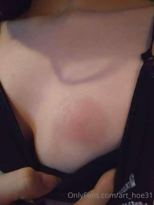 Bite marks 😋
