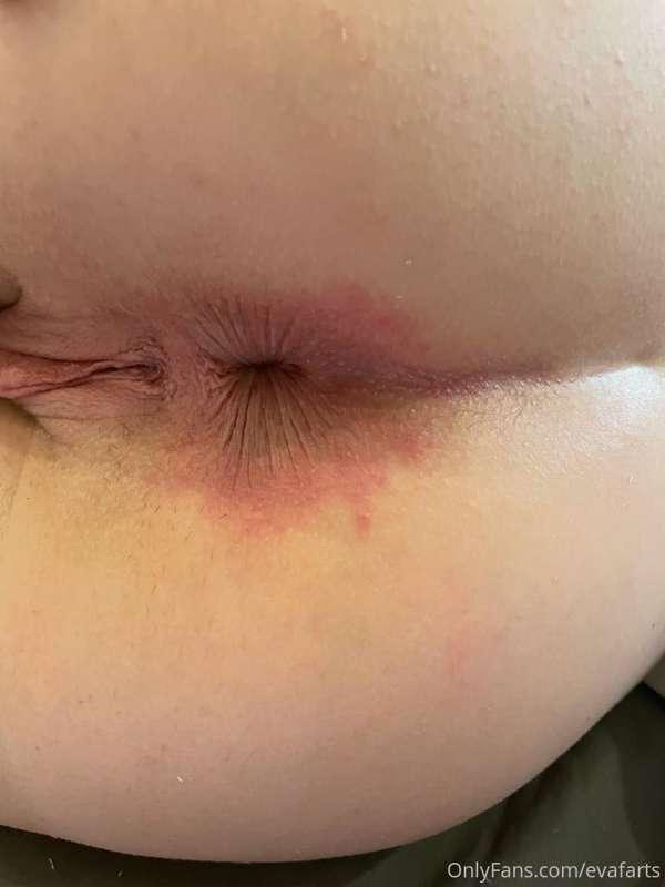 Feeling sore. Bleaching arse has had a reaction and I had cu..