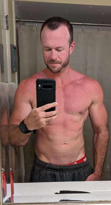 A little sunburned after the beach yesterday 🥵