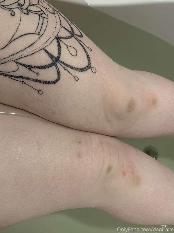 One of my favorite bruises 👅