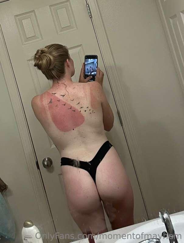 Sunburnt again ☹️