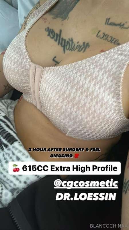 hey guys I just had surgery 2 days ago , I’m doing amazing w..