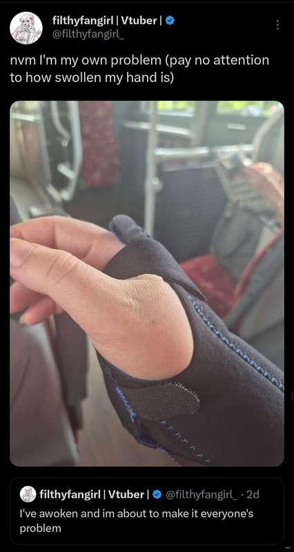 guess who fractured their wrist