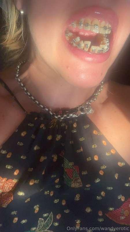 Now if all the front teeth are clamped by the wire