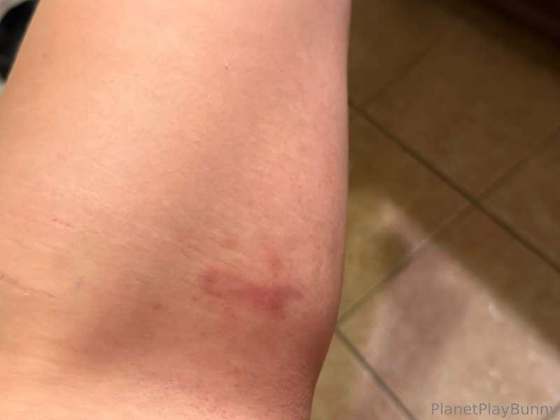 LOOK AT MY BRUISES HEHE. Sweet little aerial and Lyra kisses..