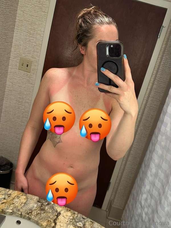 sunburnt from vacation 🙈