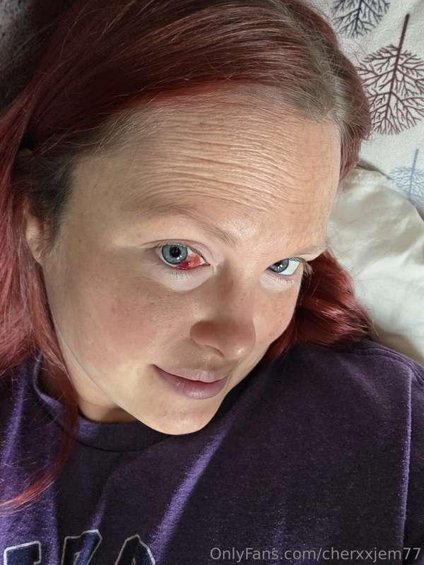 Good morning!Nothing like a Subconjunctival hemorrhage 🙃Fami..