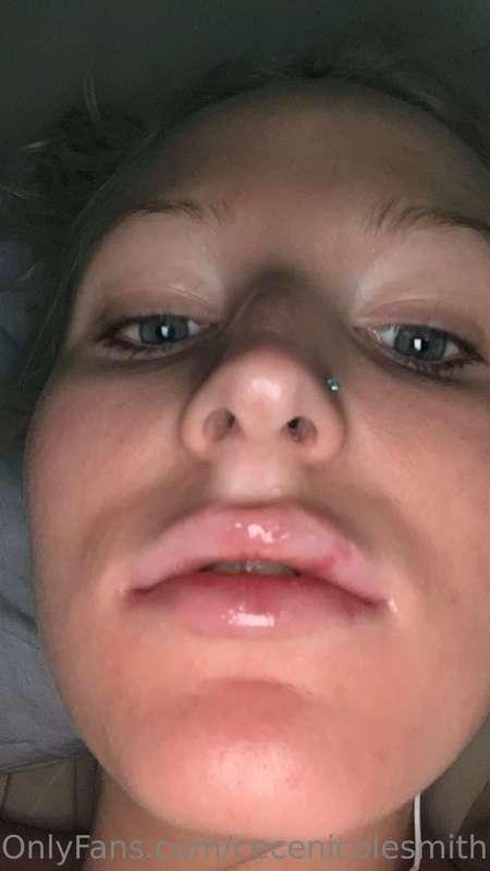 My new lips 😳 they’re not heal yet so don’t judge me