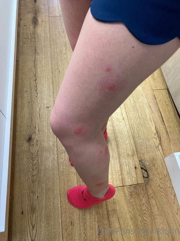 I can’t handle these mosquito bites… thus looks awful in sho..