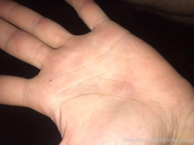 Listen I have these huge blisters, I need someone to come su..