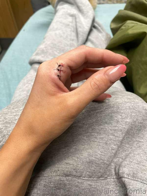 So I messed up mt hand and had to get stitches so I’m slow t..