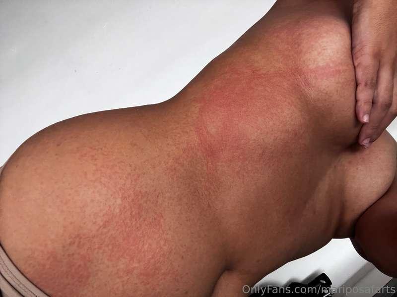 My rash is getting worse :( ill see another doctor tomorrow