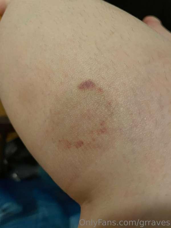Ouchie