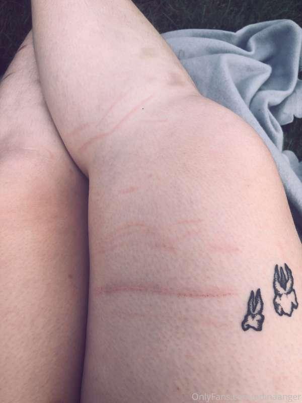 Bad girl Battle scars from Bed 🦚
