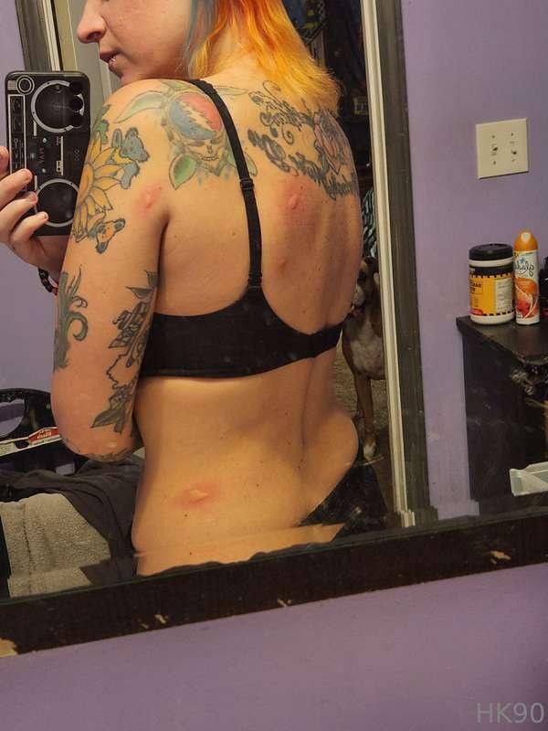 Yall.... when I say I'm allergic to mosquitoes.... this was ..
