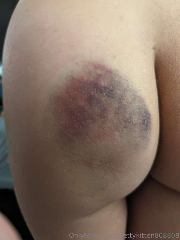 Bruise progression 🥹