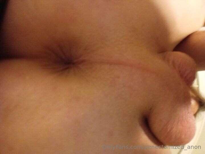 penectomized_anon image #0