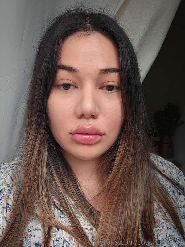 Lip fillers, day one.Damn they were sore. 😫