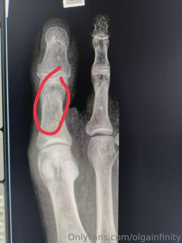 Guys, I injured my big toe (micro crack) and need some time ..