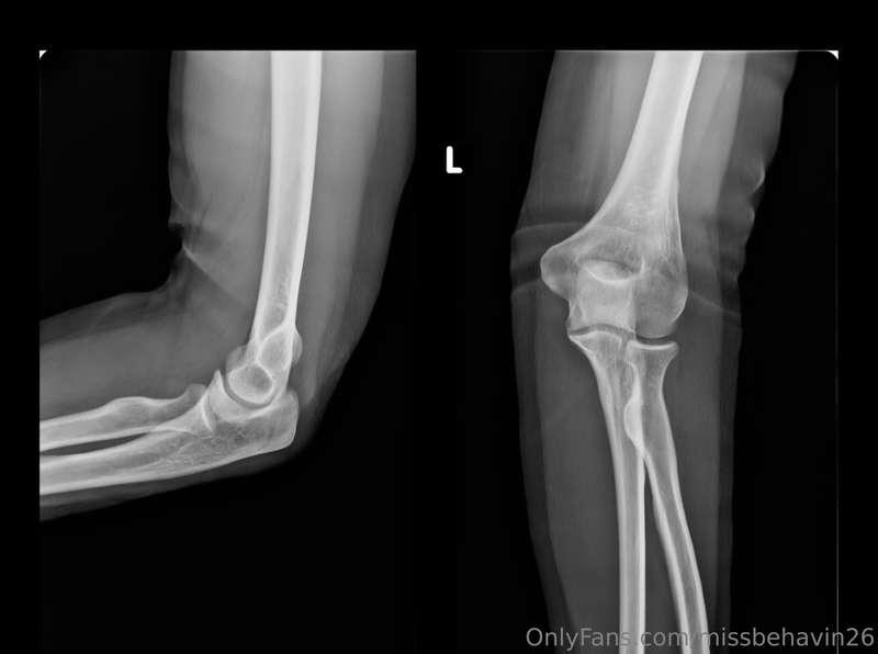 Get ready for an un-sexy post. I fell down a flight of stair..