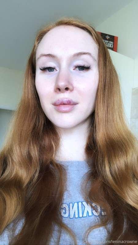 My bruisy lips are cute