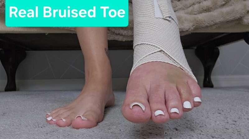 Real Broken Toe Sprained Ankle Care--->Added to @myprettyfee..