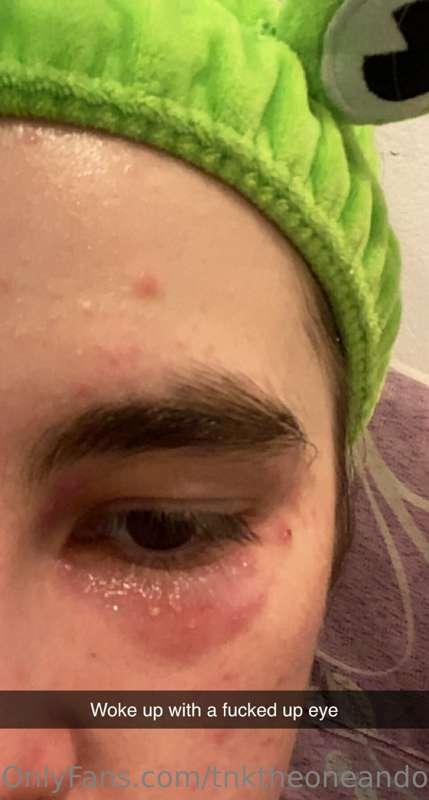 Woke up with a fucked up eye, I’ll try to post later. I don’..