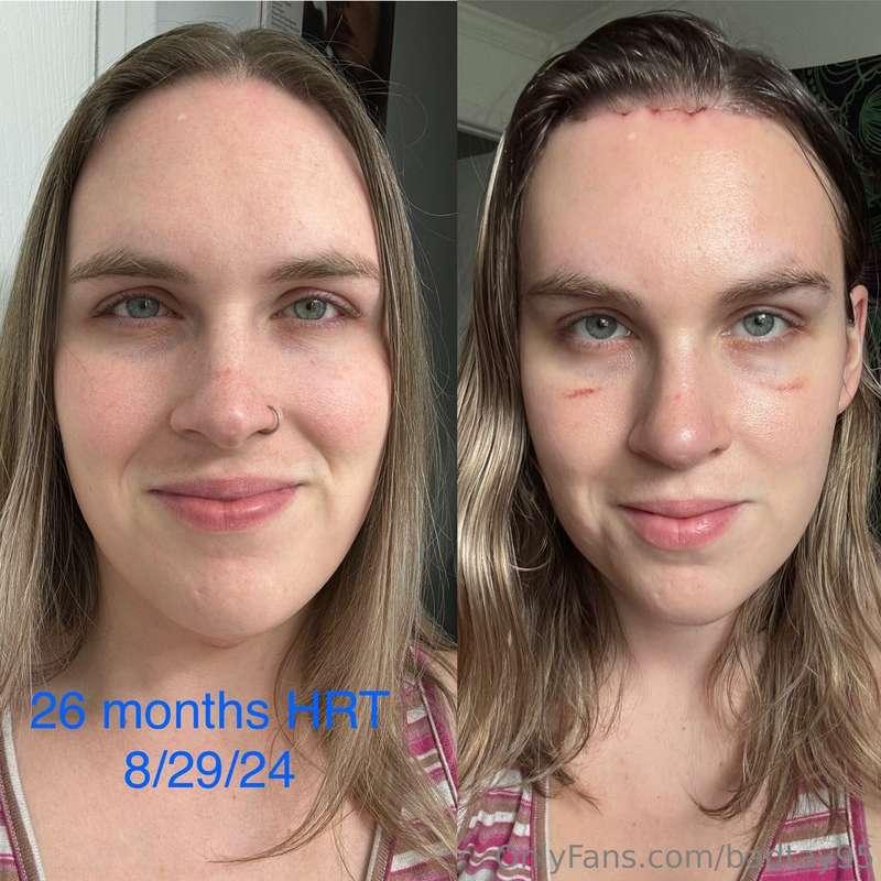Here’s an update on my appearance before vs after surgery! W..