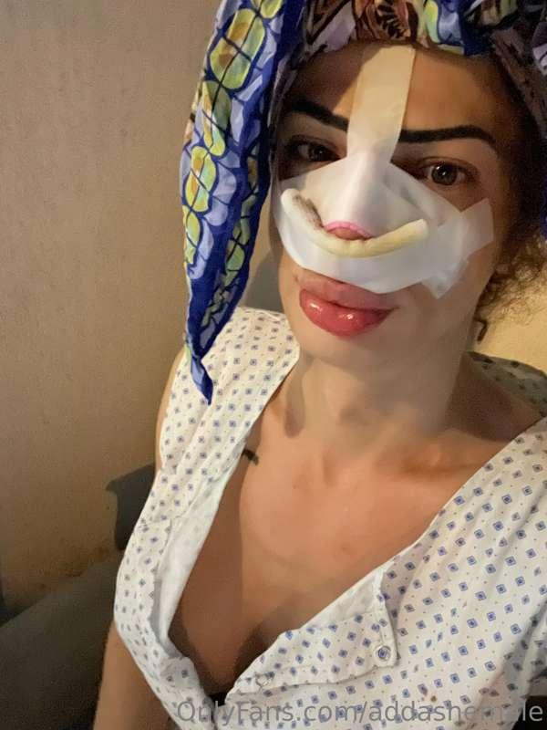 One week No work rinoplasty