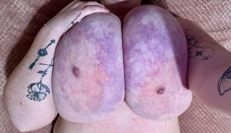 How crazy is the colour of my boobs when I’m cold 🥶 haha. It..