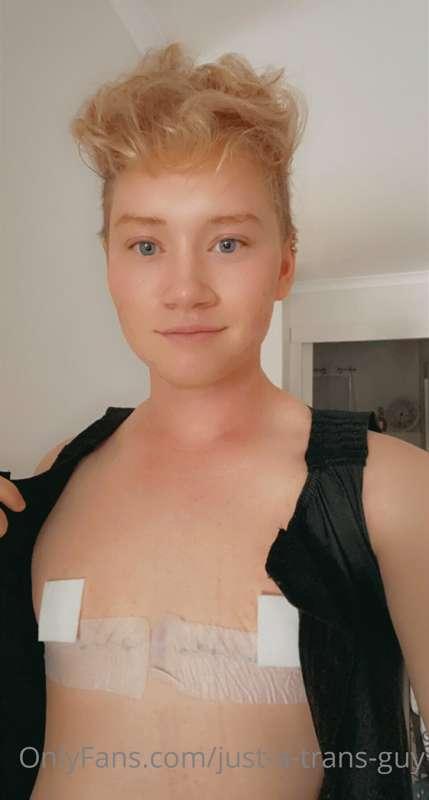 I’m so happy how my chest surgery turned out, just another 3..