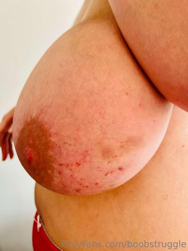 Hi guys 💋 I just wanted to share with you my bruises from th..