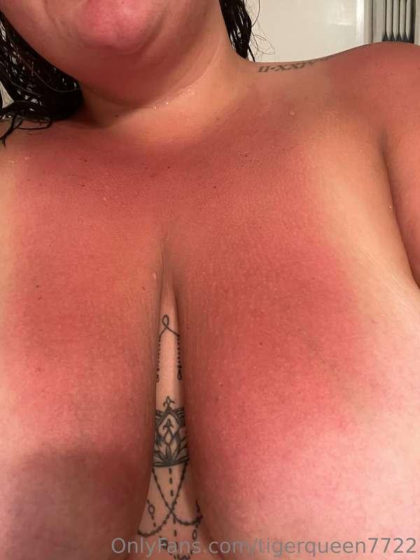 Sun burnt tities 🥵