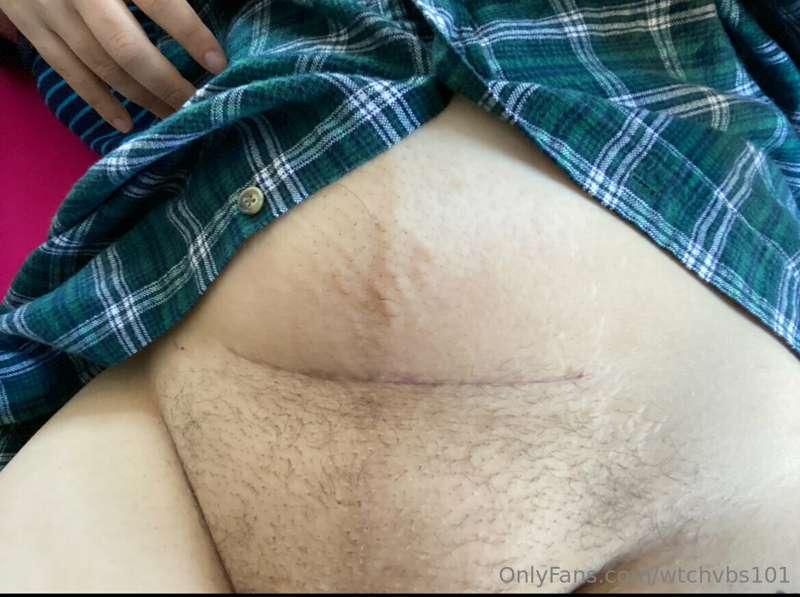 C-section incision 

Can’t believe I became a mom 18 months ..