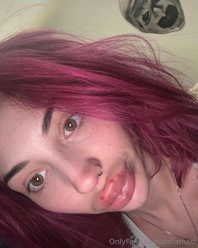 New lips fillers and Botox! It looks so good! I love how my ..