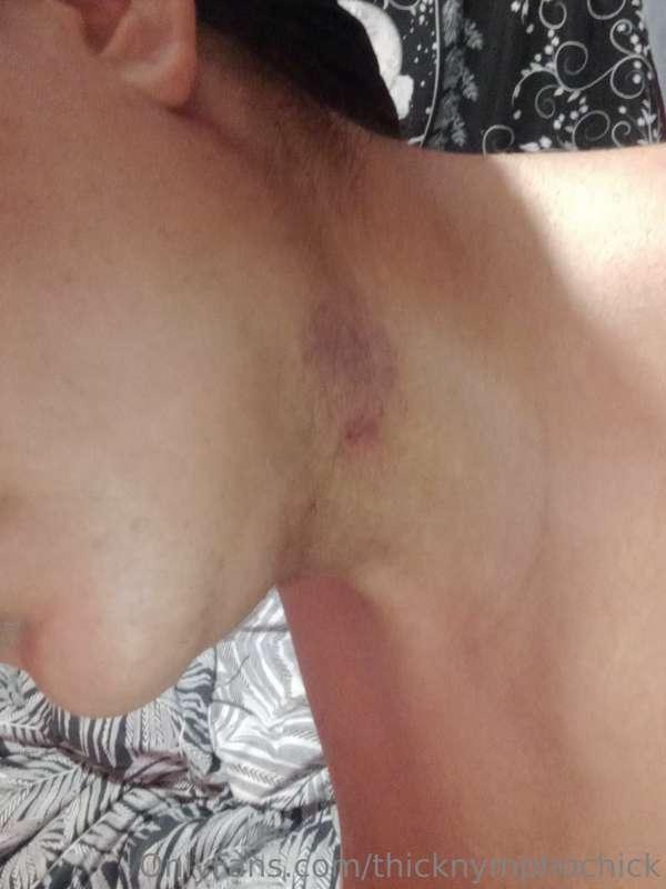 When sex gets frisky and I get bites like this.